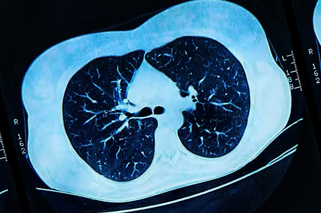 CT scan of a heart with cardiovascular disease