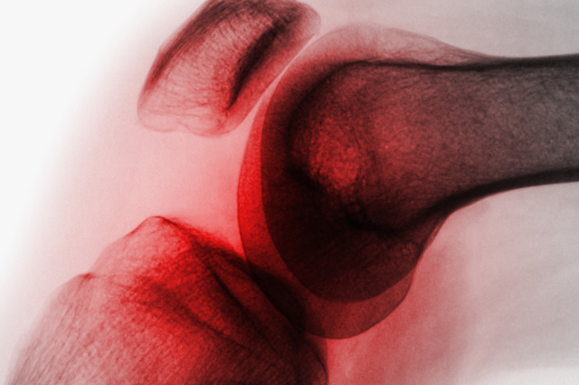 Inflammation