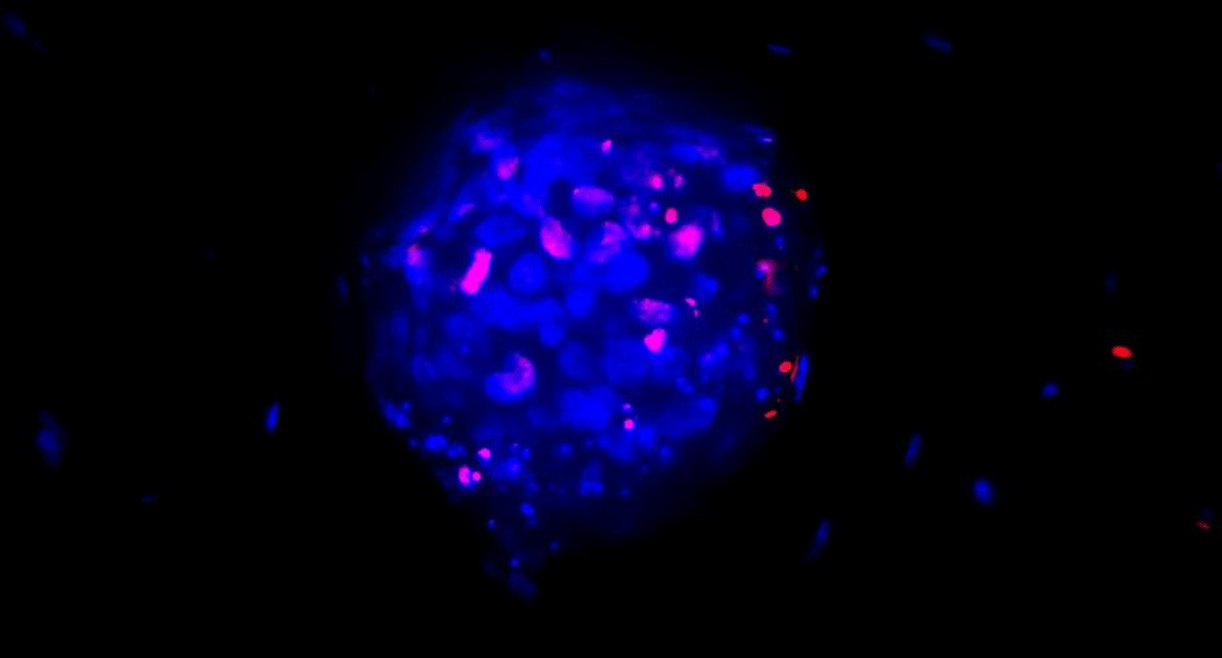 3D tumor models, in vitro cancer model