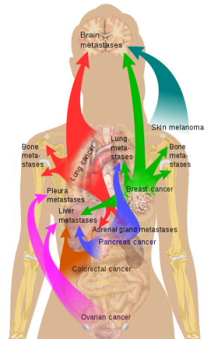 Image shows where cancer spreads to