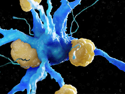 Amyloid beta plaques on a nerve cell