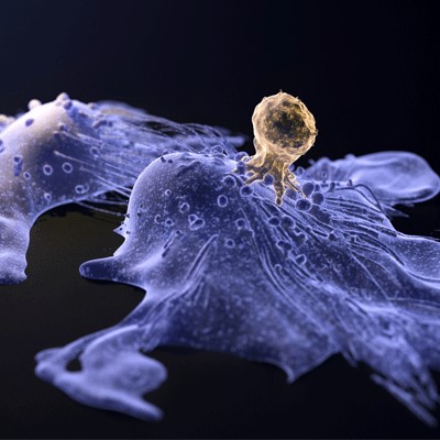 A CAR-T cell attacking cancer