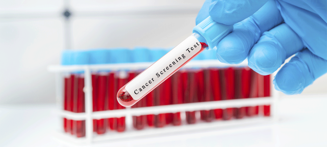Study Finds a Simple Blood Test Can Detect Early Colon Cancers | Eureka ...