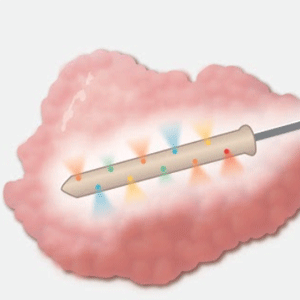 KIBUR Medical Implantable device in tumors
