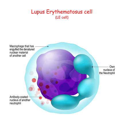 Lupus cell being engulfed.
