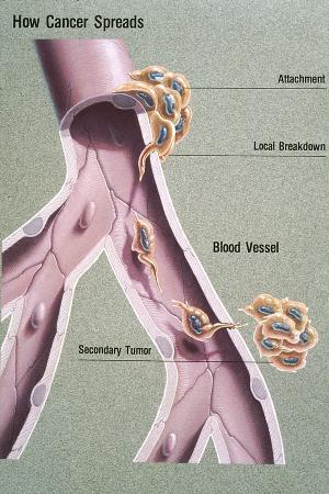 Shows the progression of metastases 