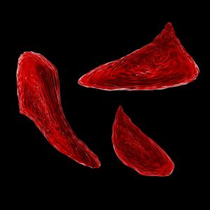 Red blood cells distorted by sickle cell anemia