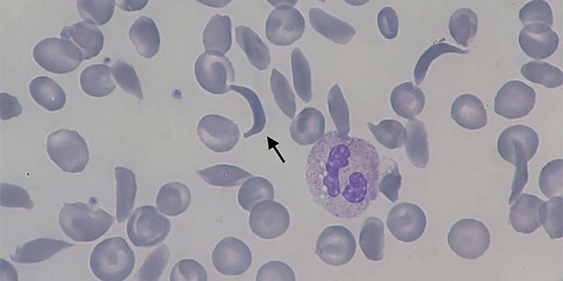 Arrow points to the sickle cells that cause the blood disorder.