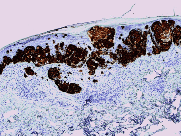 Melan-A (A103) highlights the invasion in this melanoma.