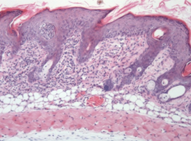 Histopathology of skin inflammation in the Psoriasis mouse model.