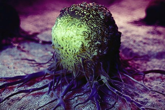 Tumors Myeloid Suppressor Cells.