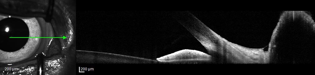 imaging of iridoconeal angle