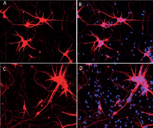 iPS stem cells for Neurological Diseases