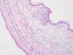 Histopathology of skin in ovalbumin induced model of atopic dermatitis.