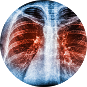 xray showing a Bacterial Lung Infection.