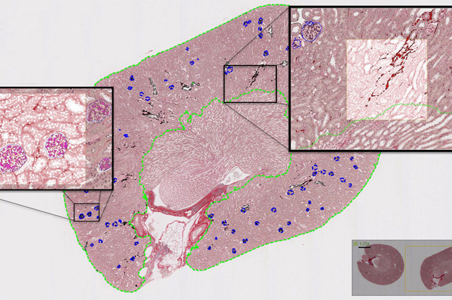 LABELED PSR kidney figure deidentified
