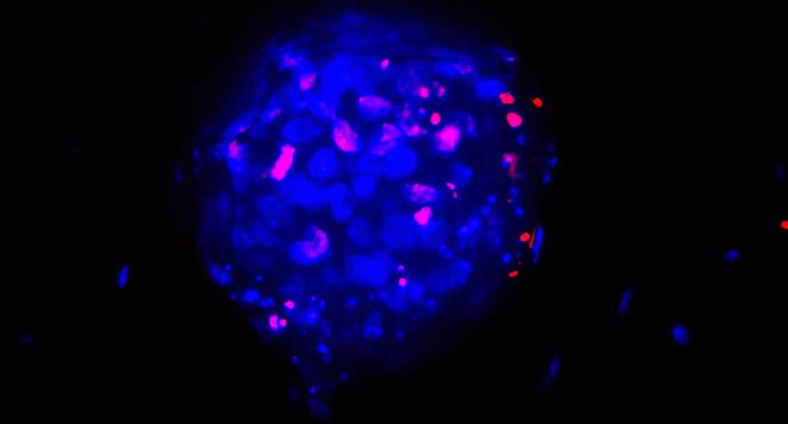 3D tumor model created by Cypre