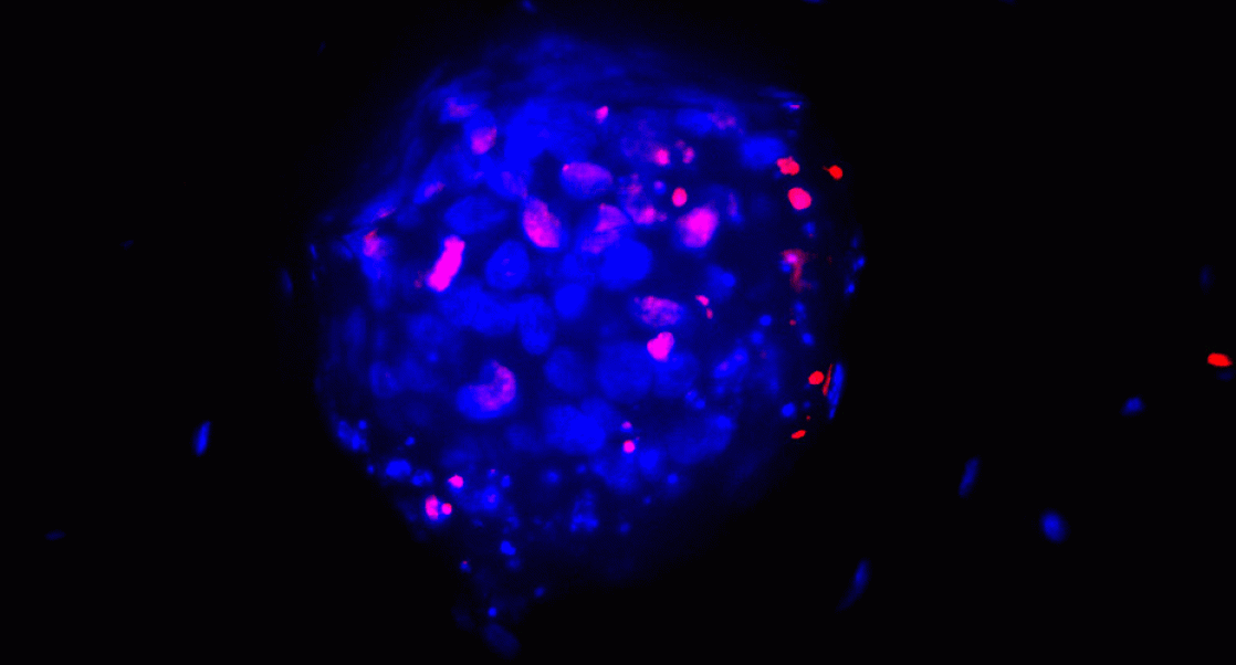 3D tumor model image shows tumors inside fibroblasts