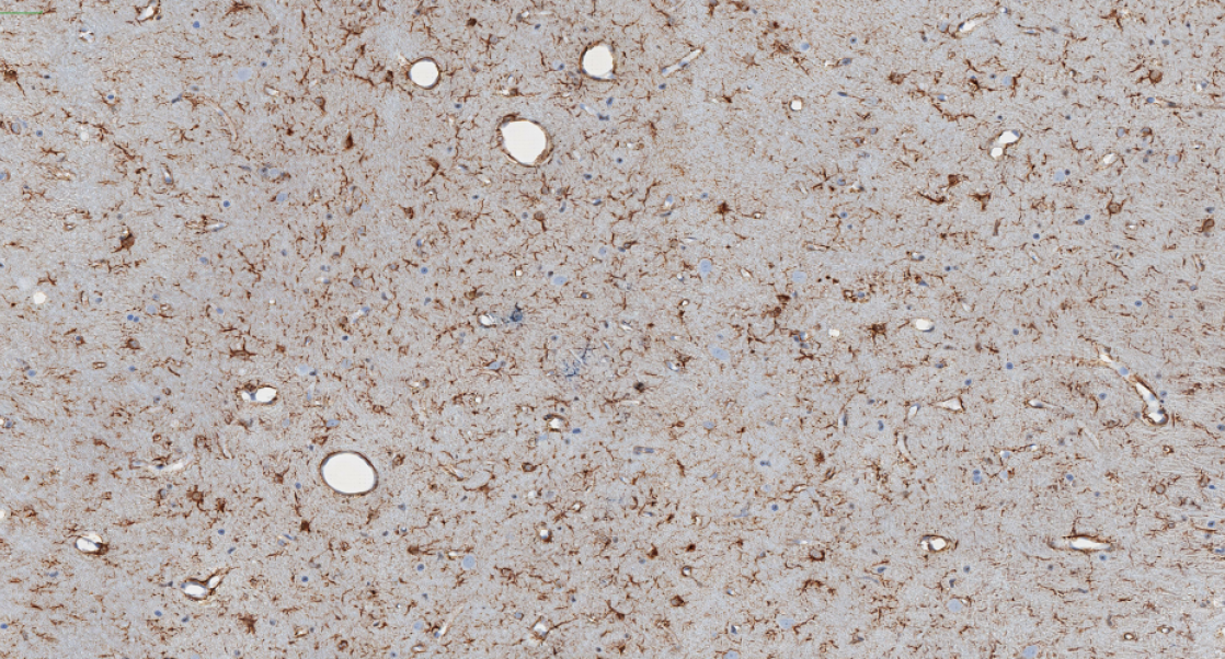 Image at top identifies astrocytes (brown) using a virtual glial fibrillary acidic protein or GFAP) 