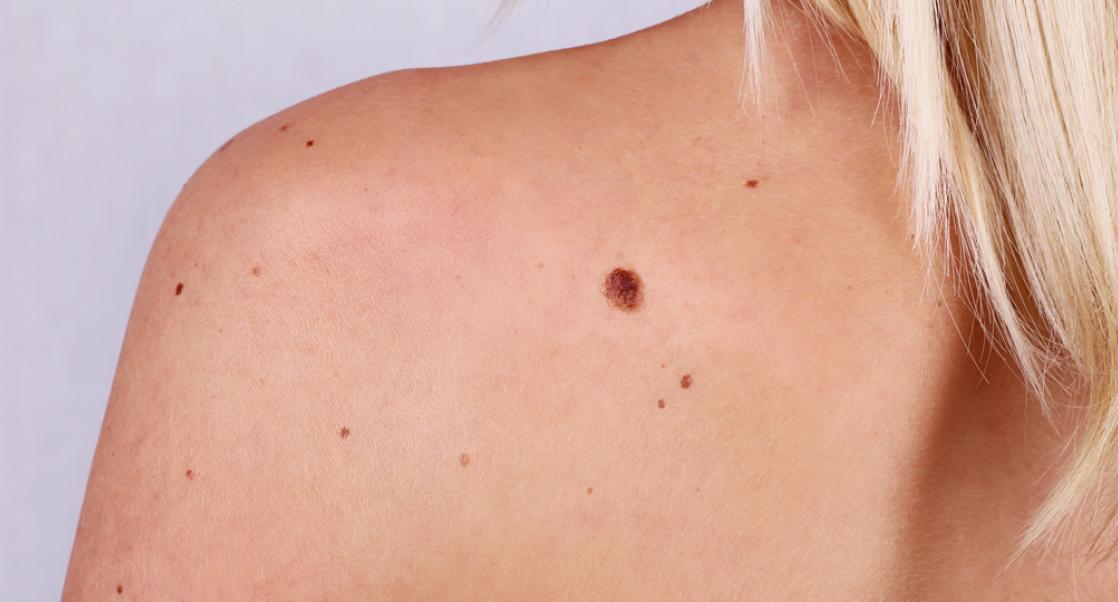 Big Drop in Melanoma Fatalities (Abstract Science May 25-31)