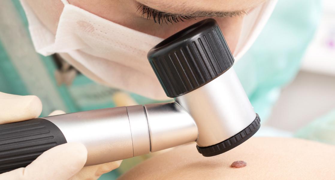 Thanks to Immunotherapy, Melanoma Deaths are Declining