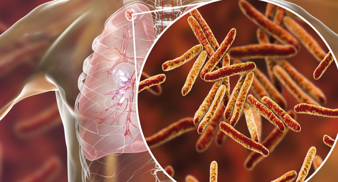 A Huge Victory Against XDR TB  (Abstract Science Aug. 12-16)