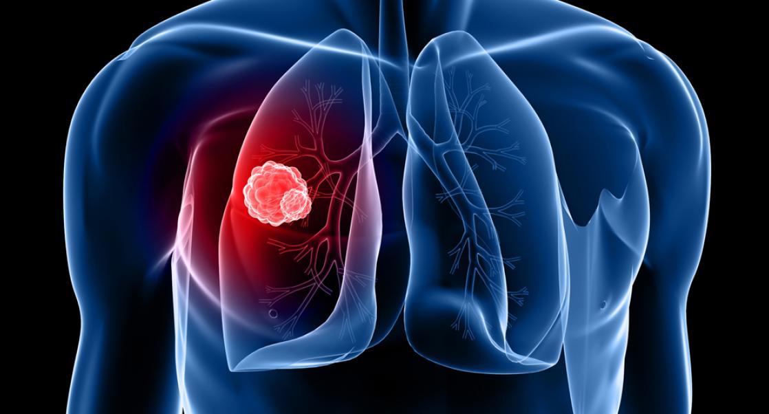 Bringing Lung Cancer Into Focus