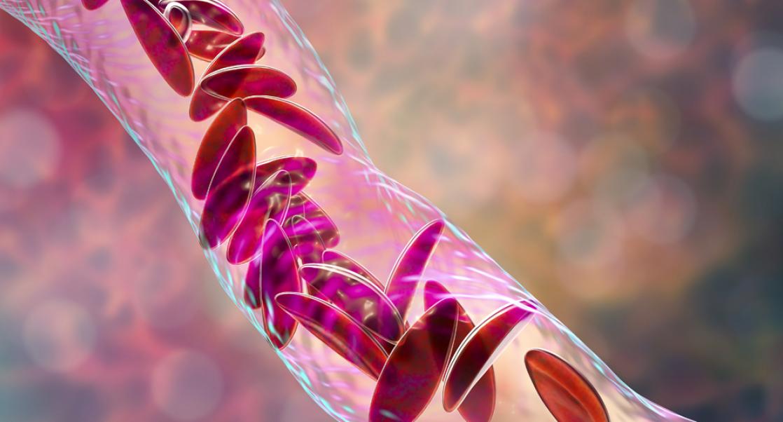 Sickle Cell Treatment Shows Promise (Abstract Science, Nov. 17 - 23)