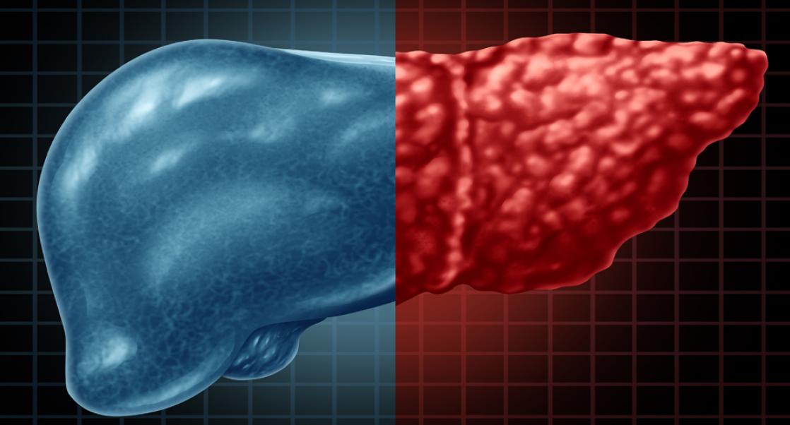 image showing healthy liver vs liver infected with NASH disease