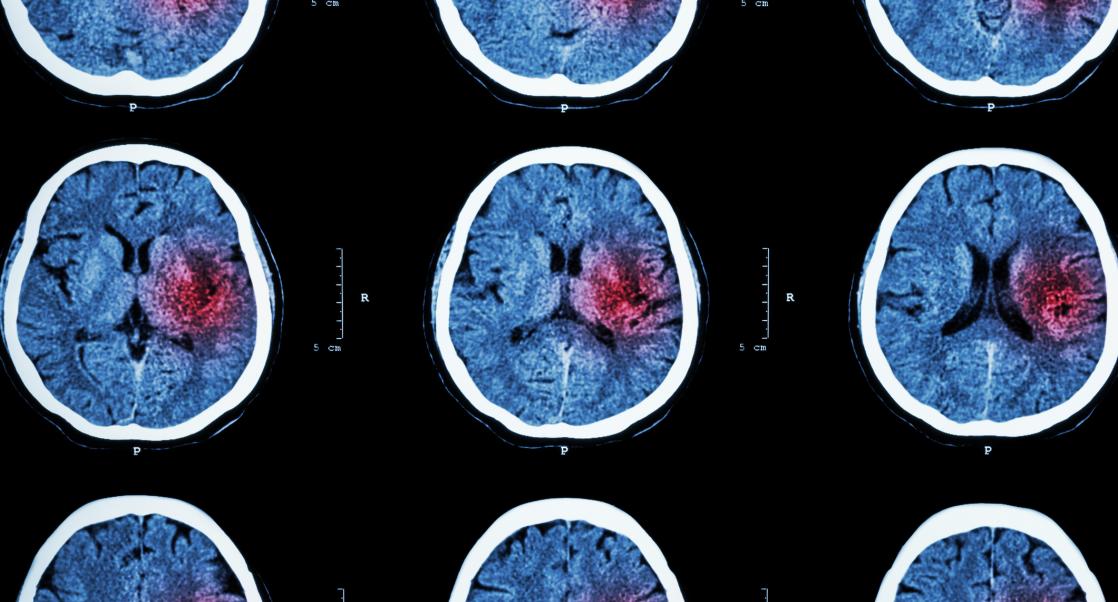 COVID Linked to Brain Disorders (Abstract Science, July 5 - 11)