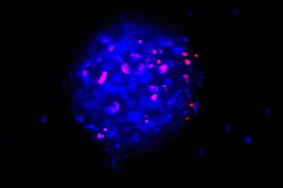 3D tumor models, in vitro cancer model