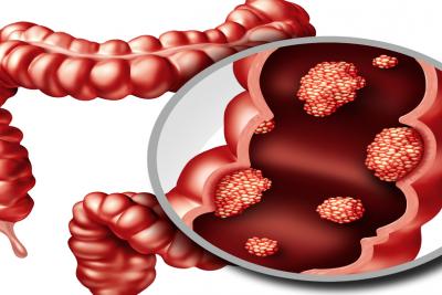 A Glimmer of Hope for Cancer’s No. 2 Killer
